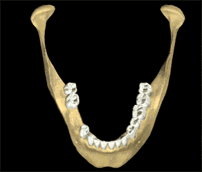bone regeneration